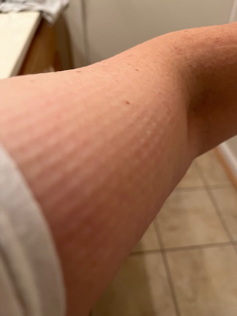 Author's arm with jacket markings from Alpinestars jacket.